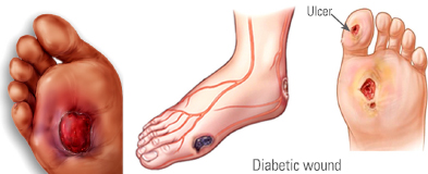 Diabetic Ulcer Treatment Gurgaon